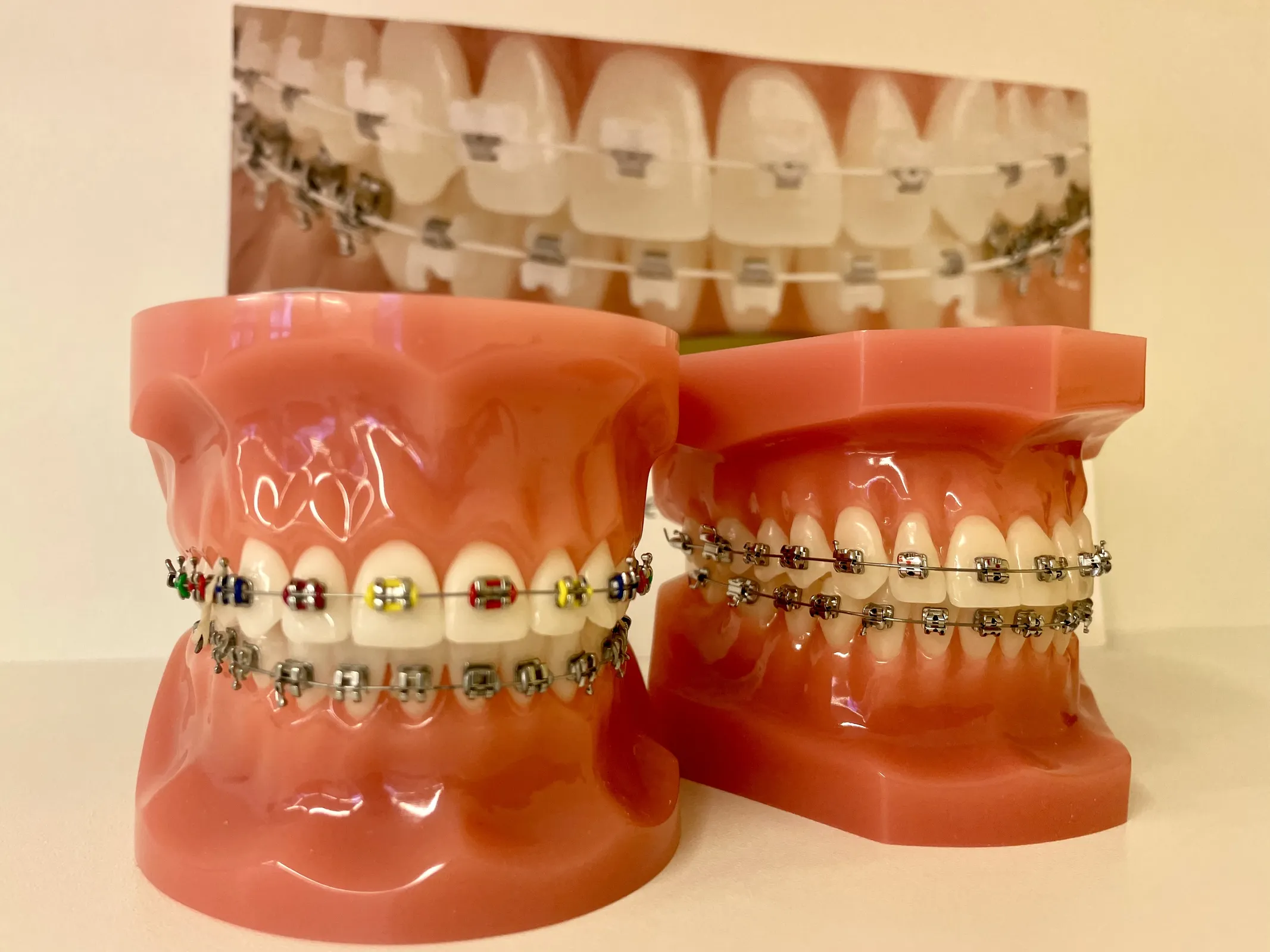 festsitzene Zahnspange